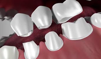 Benefits of Dental Bridges Treatment Benefits of Dental Bridges Treatment