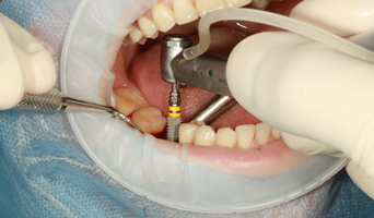 Things you should know about dental implants