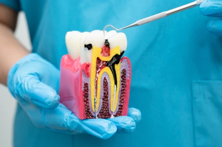 Is Root Canal Treatment in Cathedral City Really Painful?