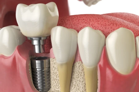 When to Consider Dental Implants in Cathedral City When to Consider Dental Implants in Cathedral City