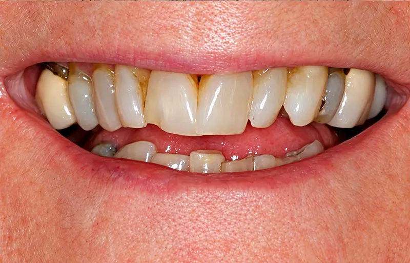 smile before implant treatment