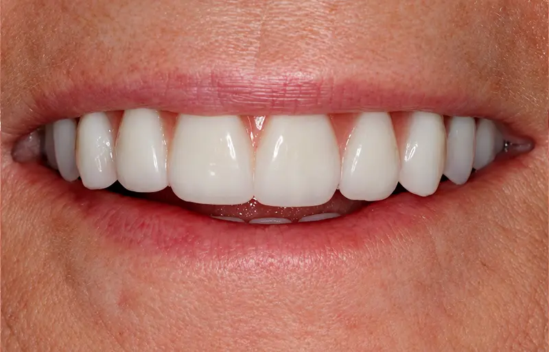 restored smile after implant treatment