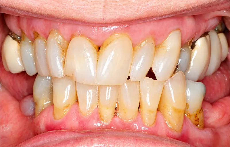 close-up of the patient's teeth before treatment