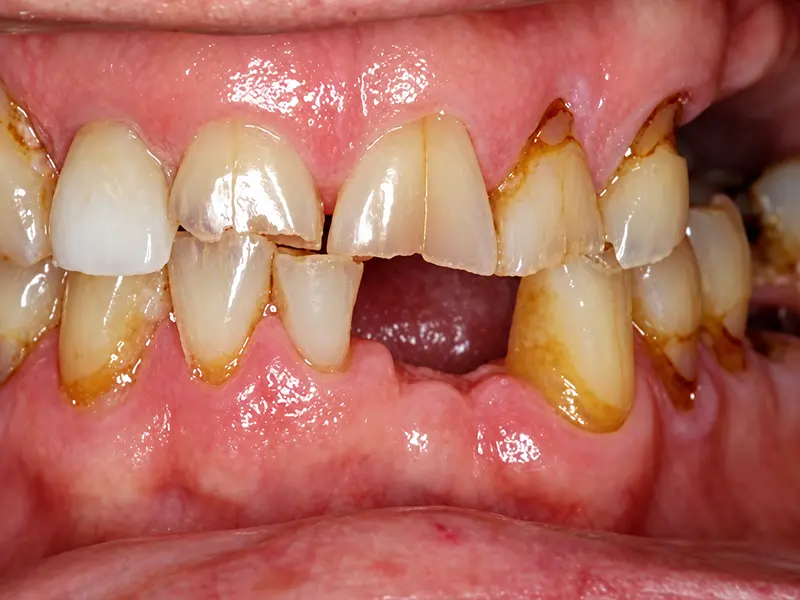 front teeth with missing teeth and extensive wear before treatment