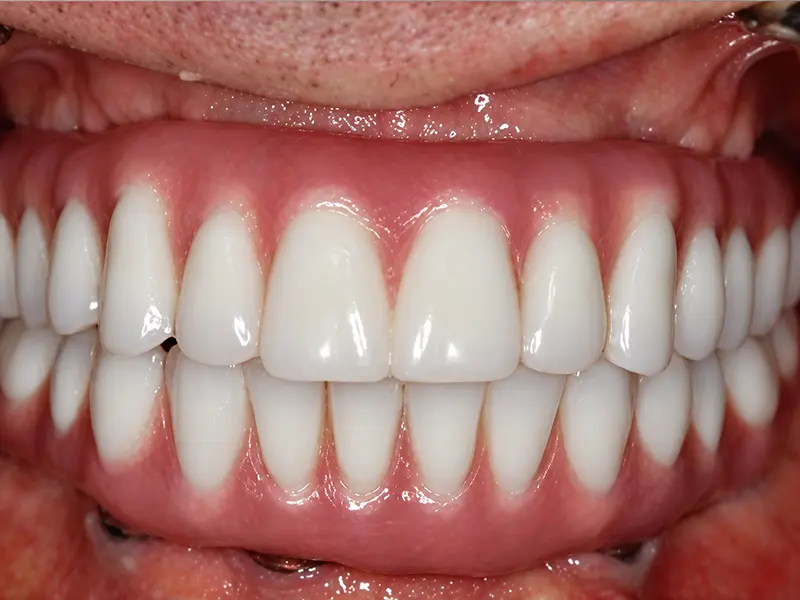 front teeth after implant treatment