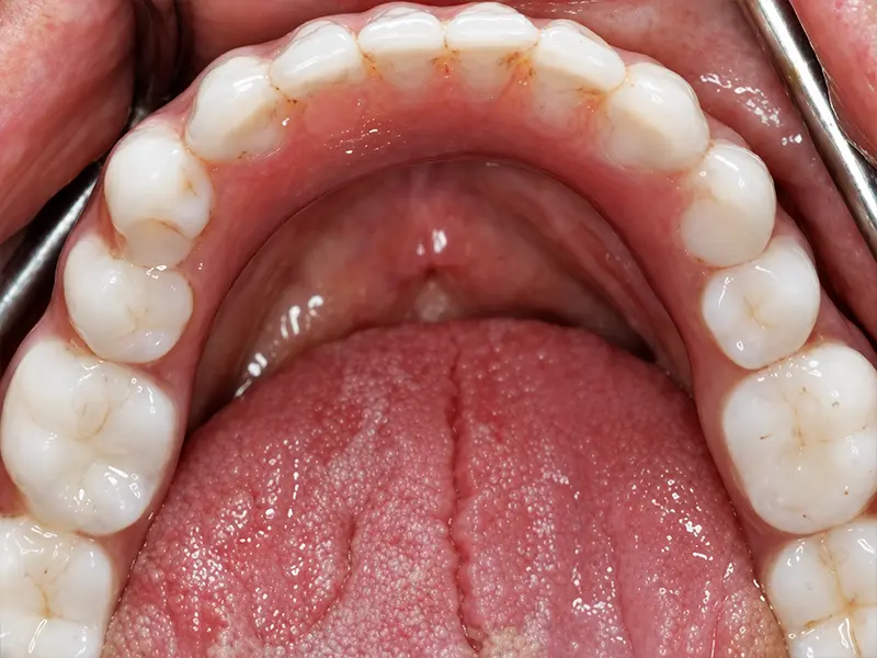 lower arch after implant treatment