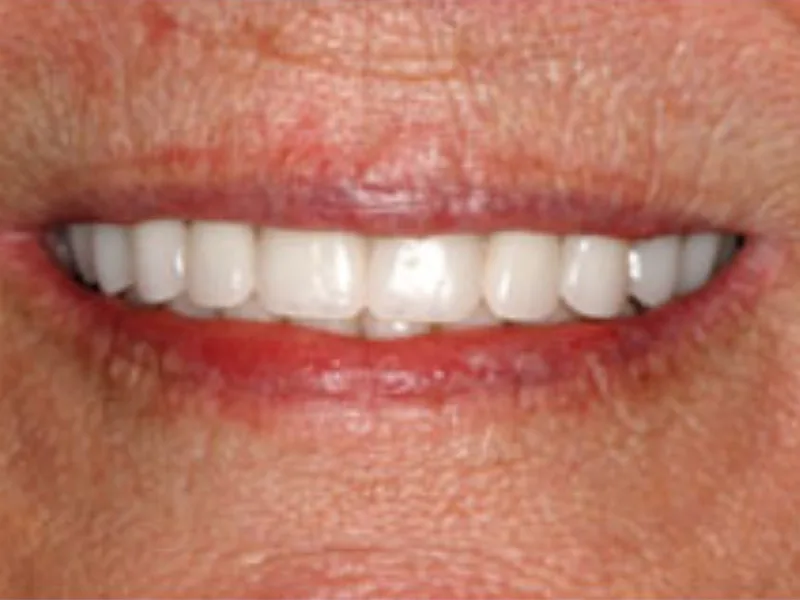 Patient smile after restoration
