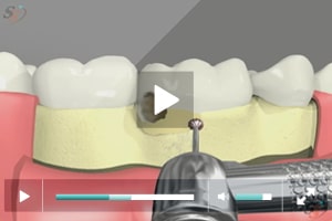 Crown Lengthening(With Bur Tool) - Scenario I