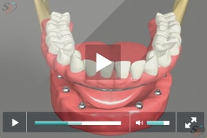 Fixed Implant Denture Option - Mandibular