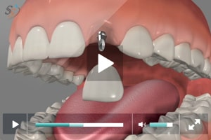 Mini Implants In Maxillary Lateral Incissor Cathedral City California