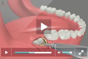 Third Molar Extraction - Disto Angular