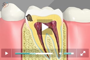 Tooth Colored Fillings - Class II