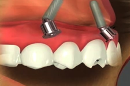 All-on-4 dental implants Cathedral City California