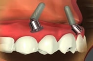 All-on-4 dental implants Cathedral City California