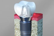 Dental Implants Cathedral City California