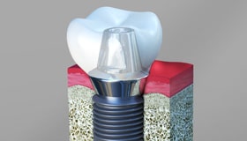 Dental Implants Cathedral City CA