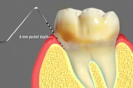 Dental Prophylaxis Cathedral City California