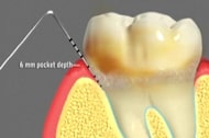 Dental Prophylaxis Dental Prophylaxis Cathedral City California