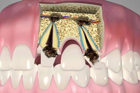 Endodontic Surgery Cathedral City California