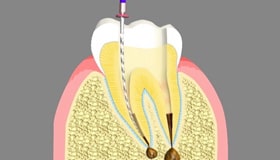 Endodontics