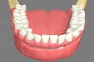 Implant supported dentures Cathedral City California