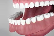 Overdentures supported by tooth root Cathedral City California