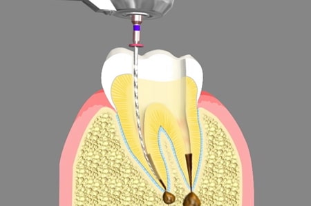 Root Canal Treatment Cathedral City California