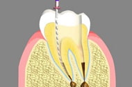 Root Canal Treatment Cathedral City California