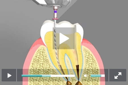 Root Canal Treatment Cathedral City California